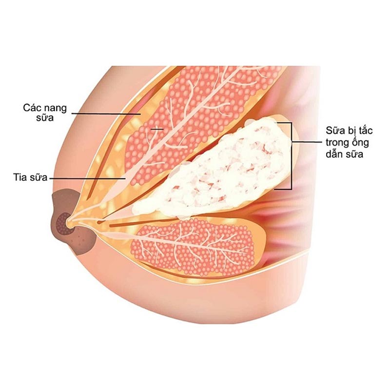 Cần làm gì khi Mẹ bị tắt sữa? Chia sẻ kinh nghiệm từ bác sĩ Bích Trang BMT