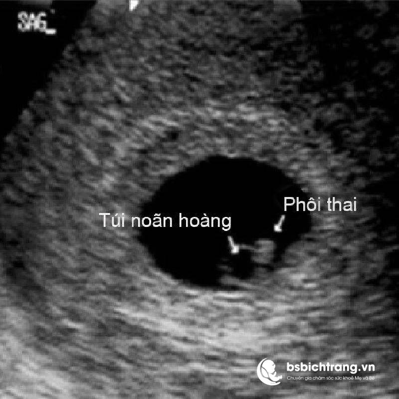 Yolksac là gì? Chia sẻ từ Bs Bích Trang BMT – Chuyên gia chăm sóc sức khoẻ Mẹ và Bé